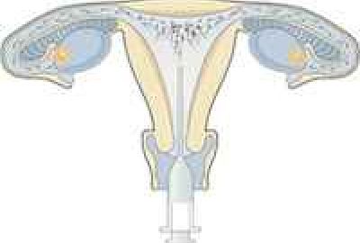 Co to jest Inseminacja (IUI)?